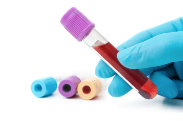 Vials of Blood for PRP Treatment