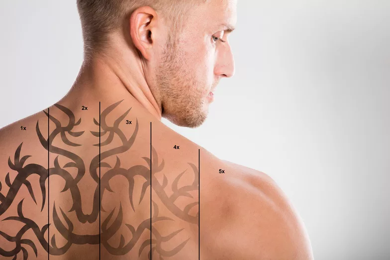 Tattoo Removal in West Vancouver  Dr Shadan Kabiri